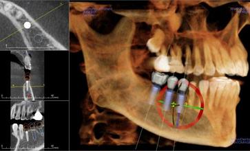 Dental implant image