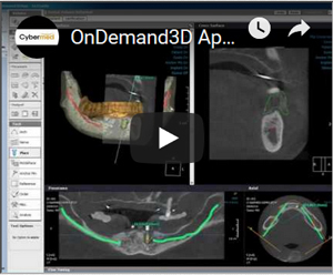 Link to YouTube Video - OnDemand3D Application demo for implant planning. After you finish implant planning, send the planning data and order surgical template.