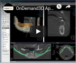Link to YouTube Video - OnDemand3D Application demo for implant planning. After you finish implant planning, you can submit the planning data and order surgical template.